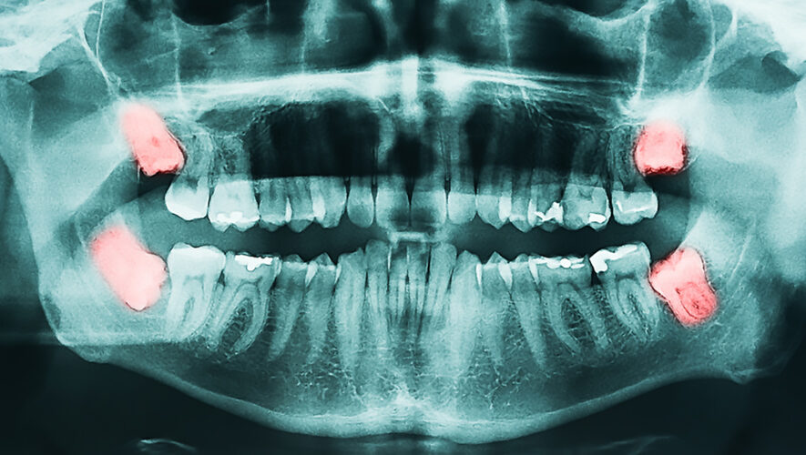20 Yaş Dişi Cerrahisi