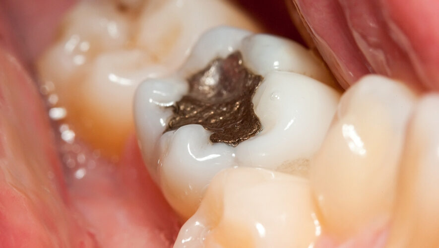 Obturation en amalgame