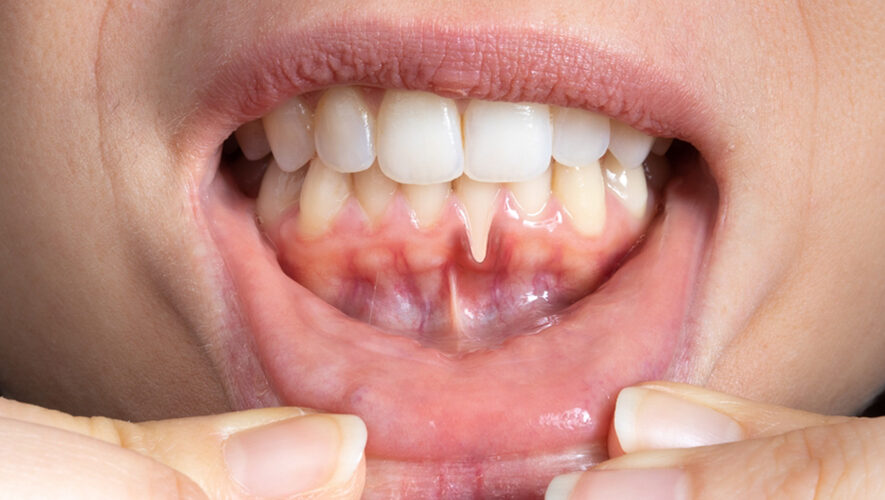 Diş Eti Çekilmesi