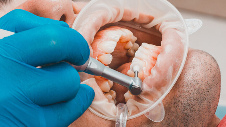 Diş Taşı Temizliği