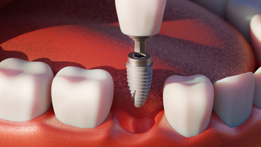 Fast&Fixed | 1 Günde İmplant Diş