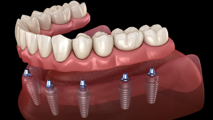 İmplant Üstü Protezler
