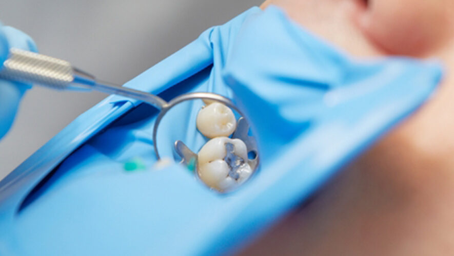 Obturation composite