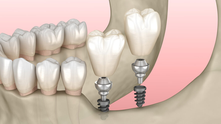Mini Dental İmplantlar