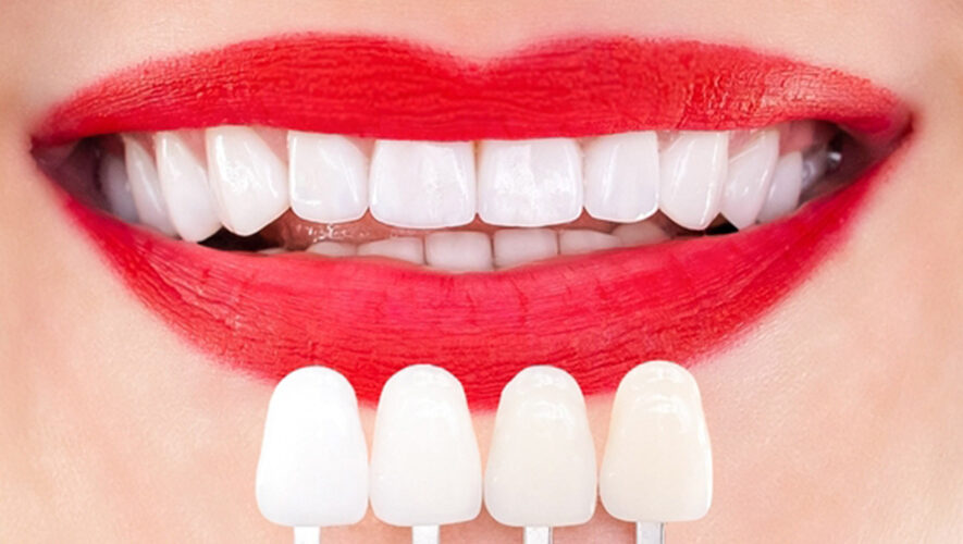 Obturation en porcelaine