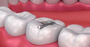 Amalgam Dolgu Nedir?