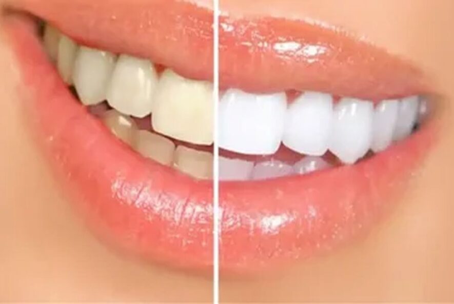 Diş Beyazlatma Nedir?