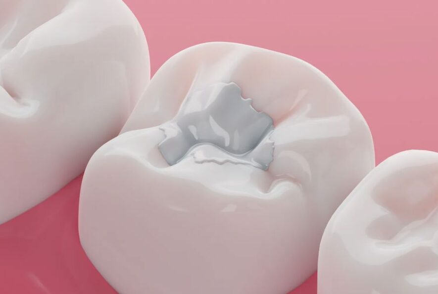 Kompozit Dolgu Nedir?