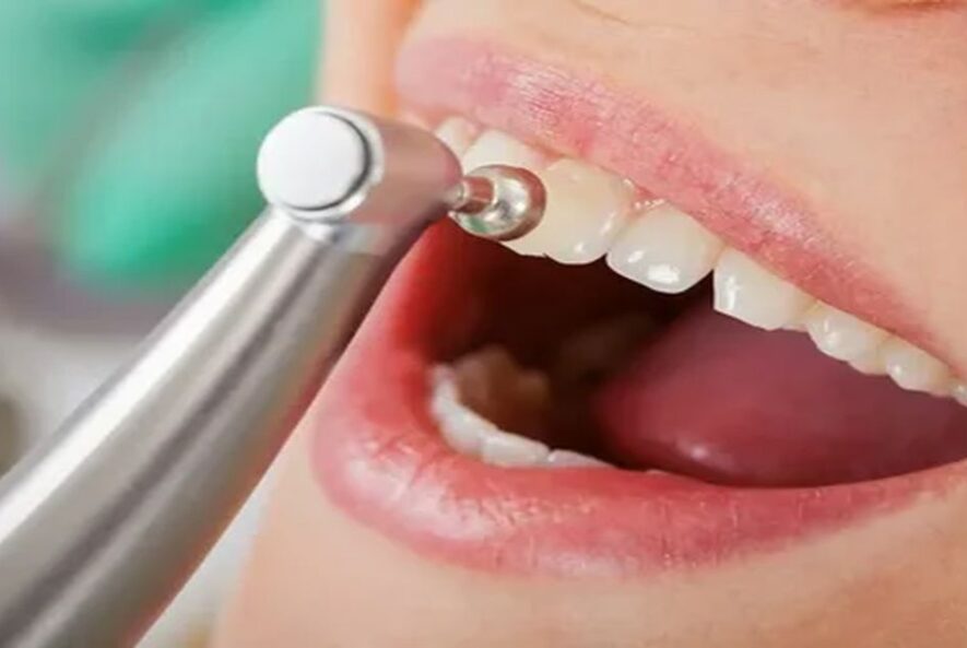 Diş Taşı Temizliği Nasıl Yapılır?