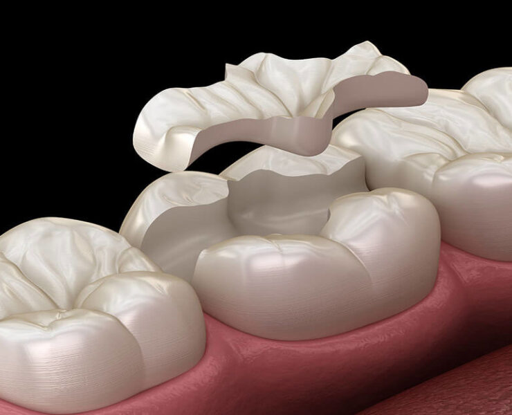 Porselen Dolgu Tedavisi