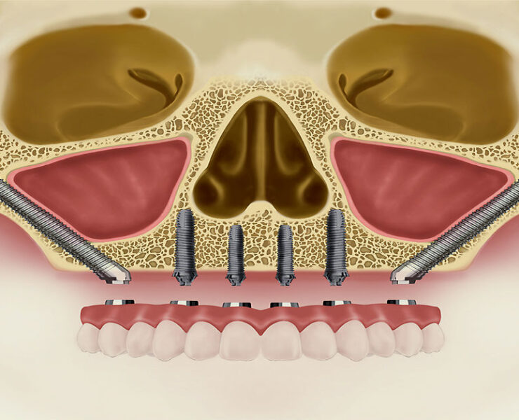 Zigoma İmplant Tedavisi