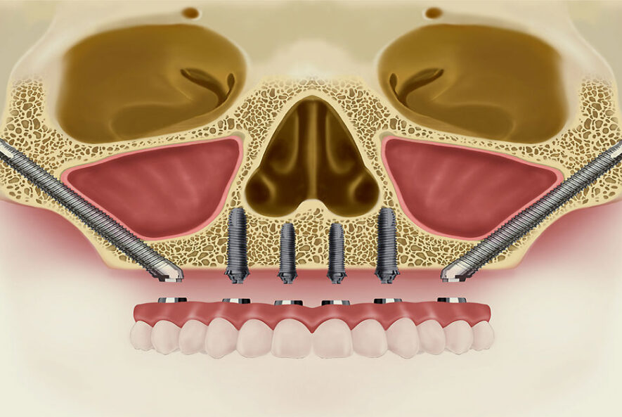 Zigoma İmplant Tedavisi
