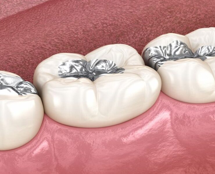 Amalgam Dolgu Nasıl Yapılır?