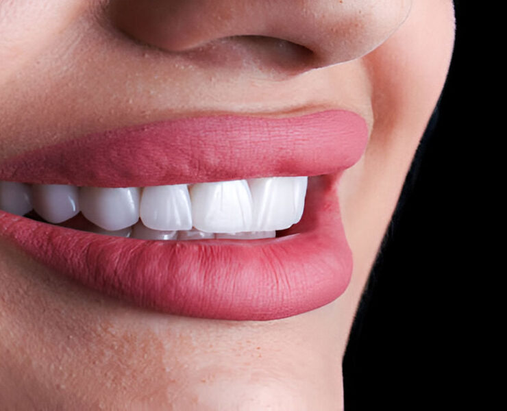 Zirkonyum İmplant Nasıl Yapılır?